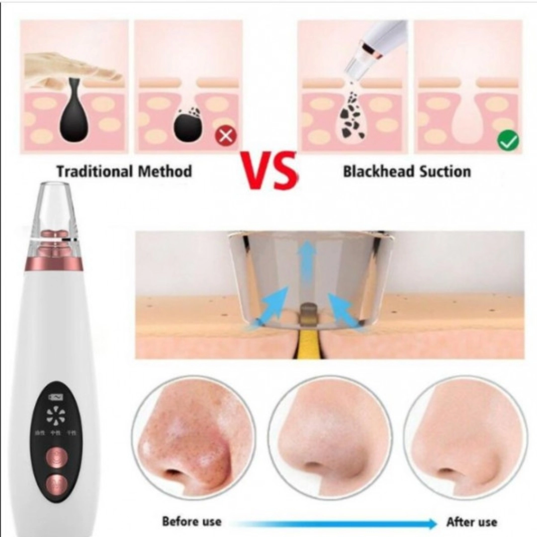Electric Vacuum Electric Acne / Blackhead Remover Extractor 6 Suction ...