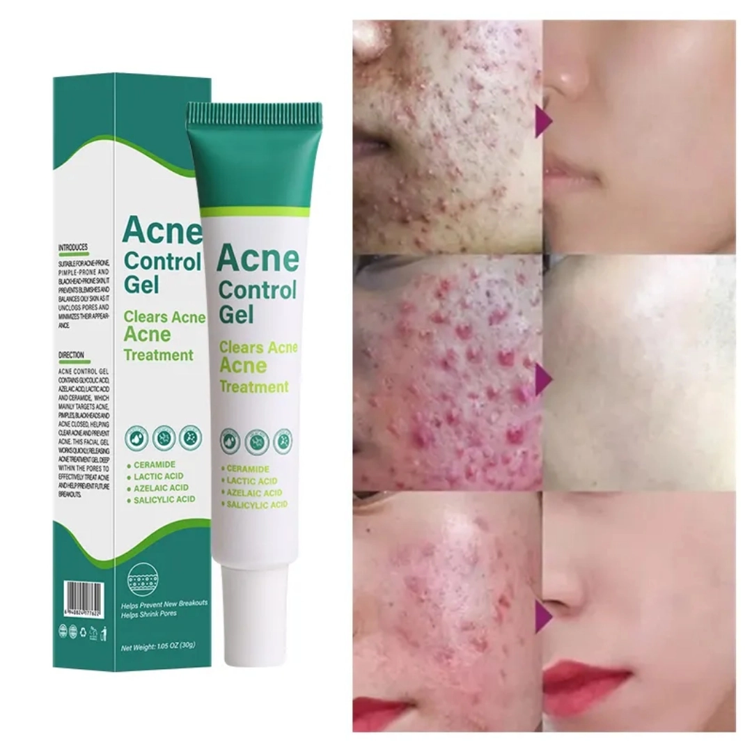Acne Control Gel Clears Acne Acne Treatment